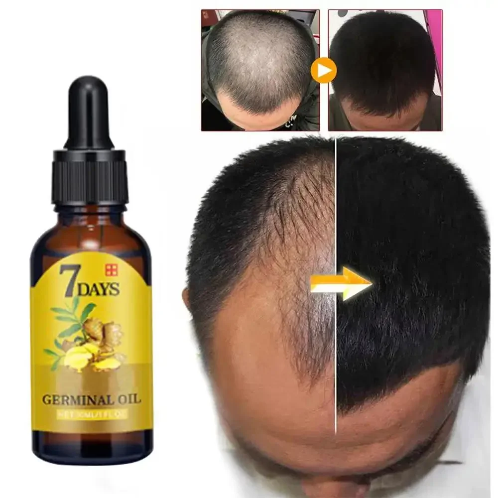 Hair Care Fragrance Essential Oil - 育毛ジンジャー高速成長髪エッセンシャルオイルヘアケア損失防止オイル頭皮トリートメント男性女性ダメージヘア