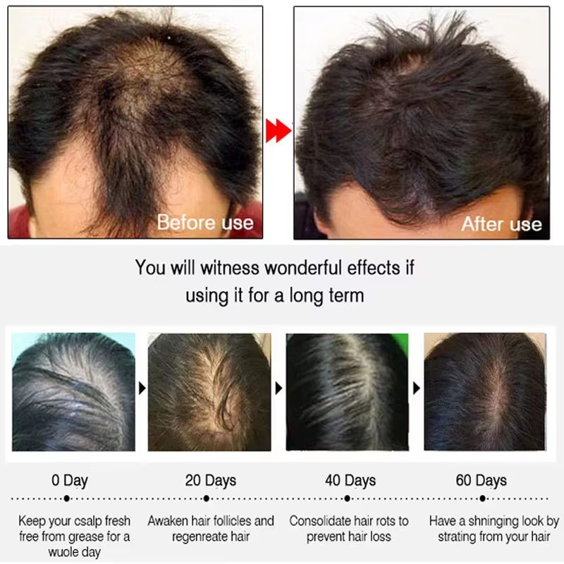 速効性ジンジャーヘアグローススプレー、毛根育成、脱毛防止、育 - Hair Care Nature のレビューと価格